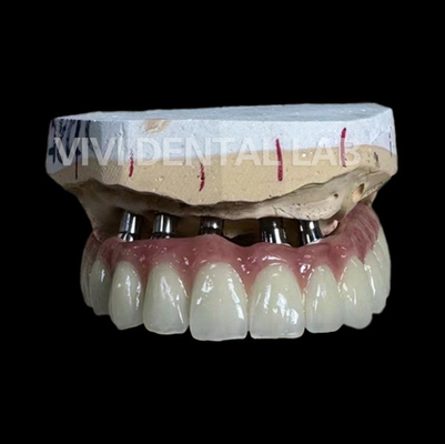 معمل طب الأسنان Total Implant PFM Bridge China Dental Lab