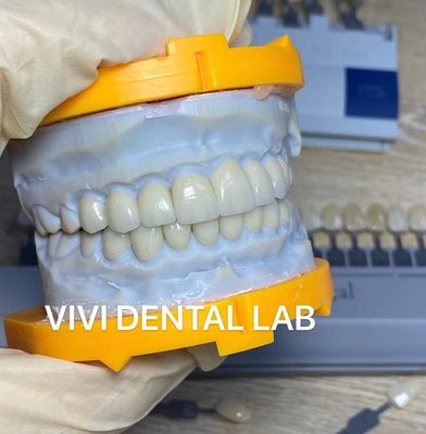 أسنان عالية التجميل Emax Laminate Veneers Incisal Translucency China Dental Lab